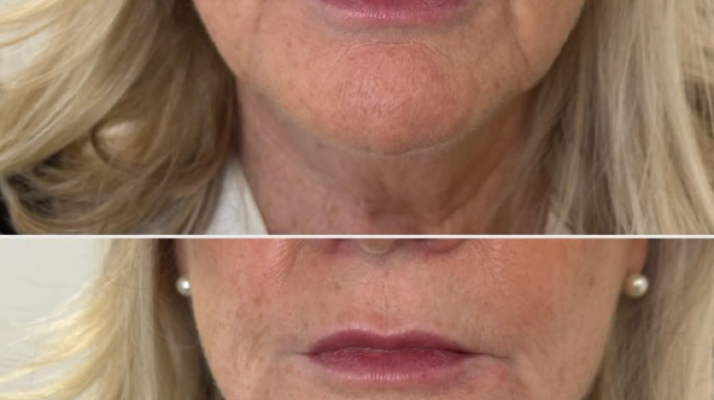 Case Study: Beautiful Marionette Line Transformation